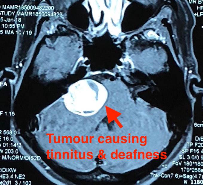 ENT Ear Nose Throat MRI showing tumour causing deafness
