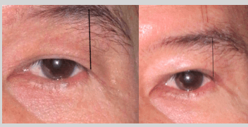 Double eye lid surgery done without brow lift showing lowered eye brow