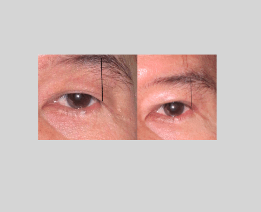 Double eye lid surgery done without brow lift showing lowered eye brow