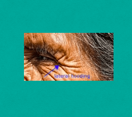 Double Eyelid with lateral hooding