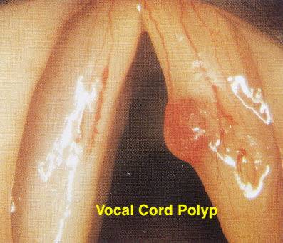 ENT Ear Nose Throat Hoarseness vocal cord polyp