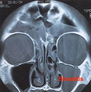 ENT Ear Nose Throat sinusitis