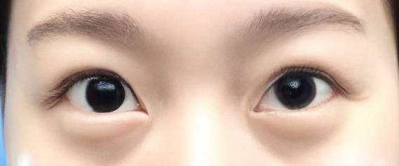post-op appearance of Korean "big eye" double eye lid surgery showing rounded eyes