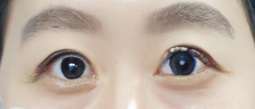 after double eye lid surgery- Korean "big eye" operation showing lid retraction and rounded eyes
