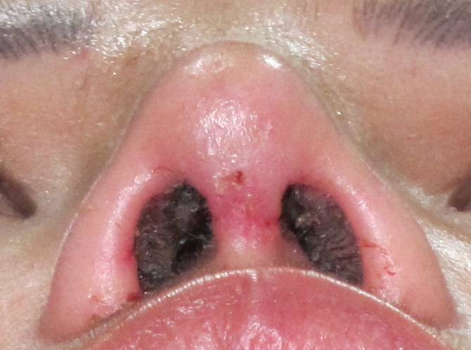 rhinoplasty photo of ugly nasal tip