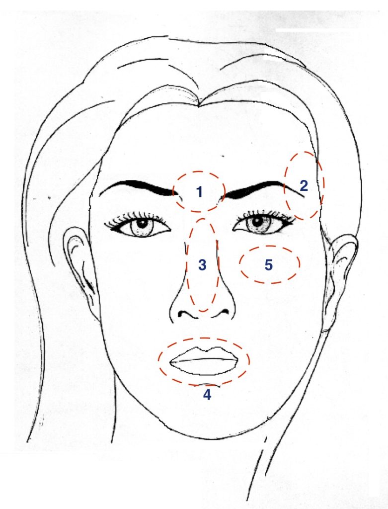 Danger zones of the face where filler injections can cause blindness