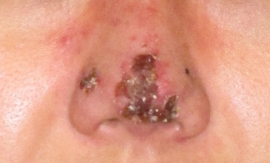 Nose Tip with dead skin from filler injection