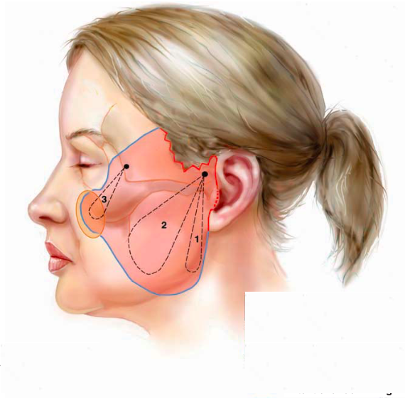 Illustration of mini facelift surgery singapore
