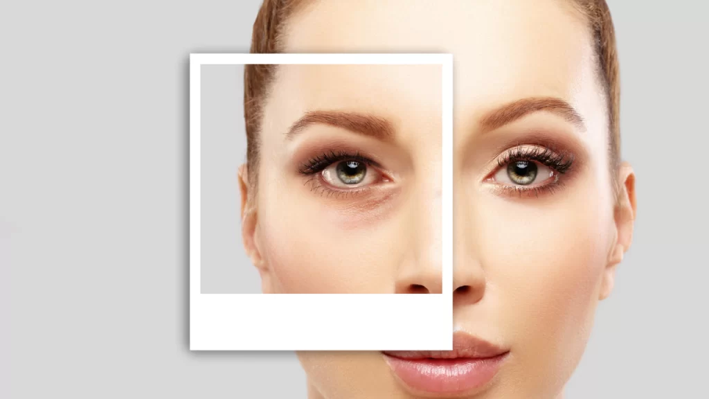 Image of before and after image of Blepharoplasty