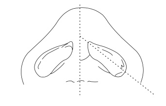 Angle of nostrils