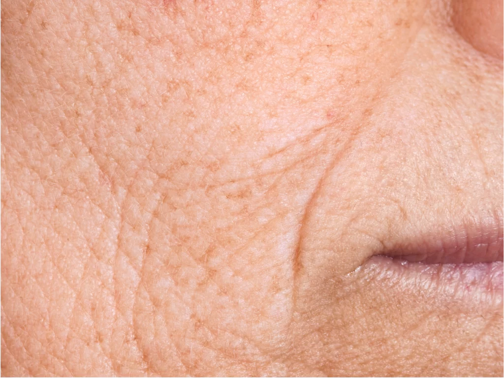 Photo of Deep Wrinkles for Facelift Singapore