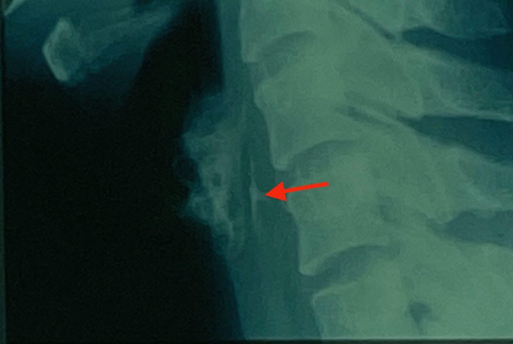 X-ray of a swallowed fish bone