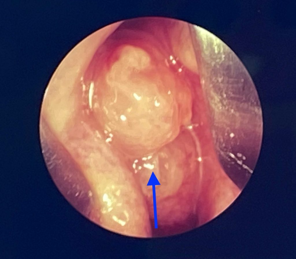 Diseases of the Nose - photo of nasal polyps