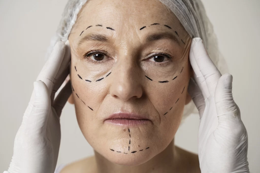 Photo of woman undergoing facelift surgery Singapore