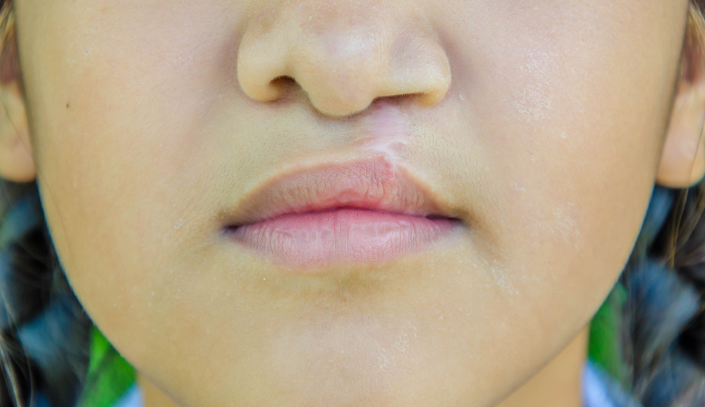 Deformed Nose