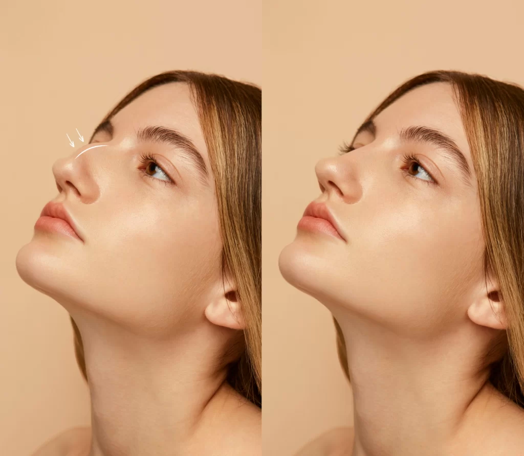 Rhinoplasty singapore before and after