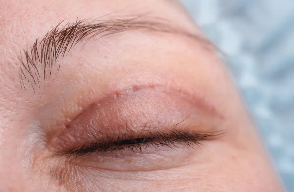 Photo of upper eyelid surgery incision