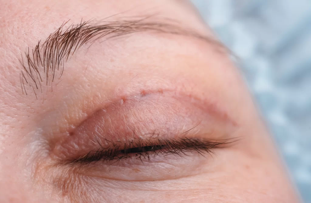 Photo of scar after eyelid surgery