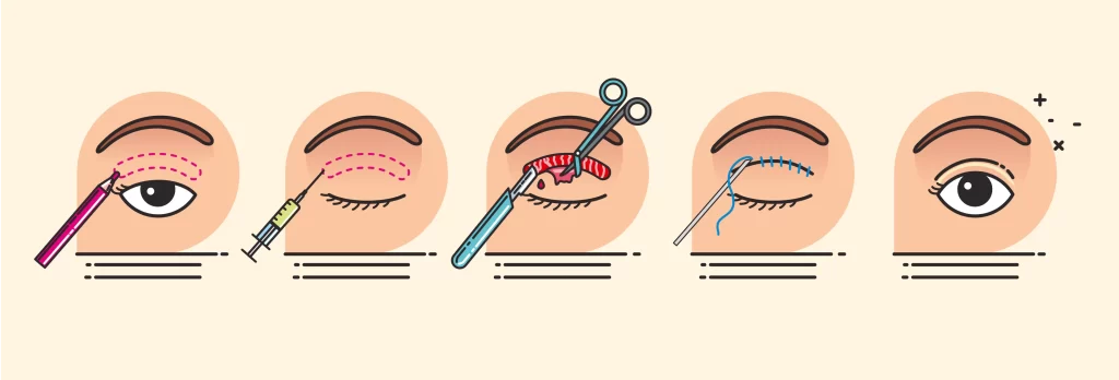 Illustration of incisional double eyelid surgery