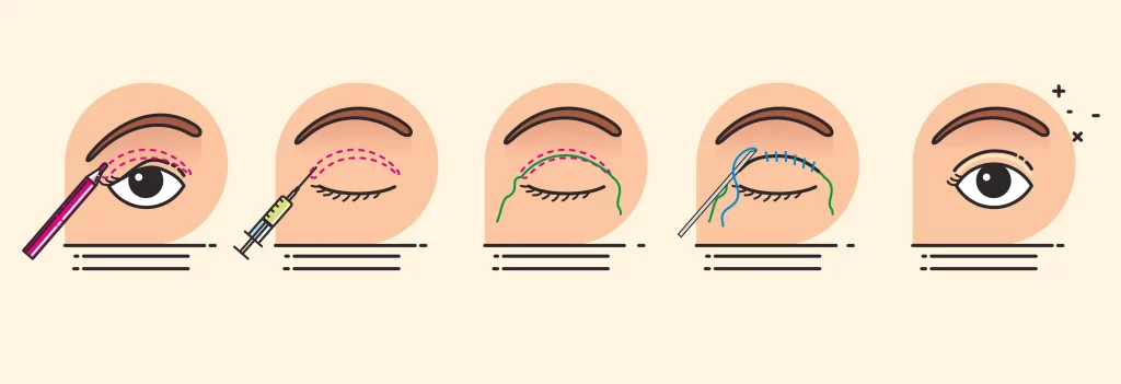 Illustration of non-incisional double eyelid surgery