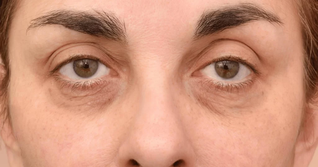 Photo of woman with under eye bags