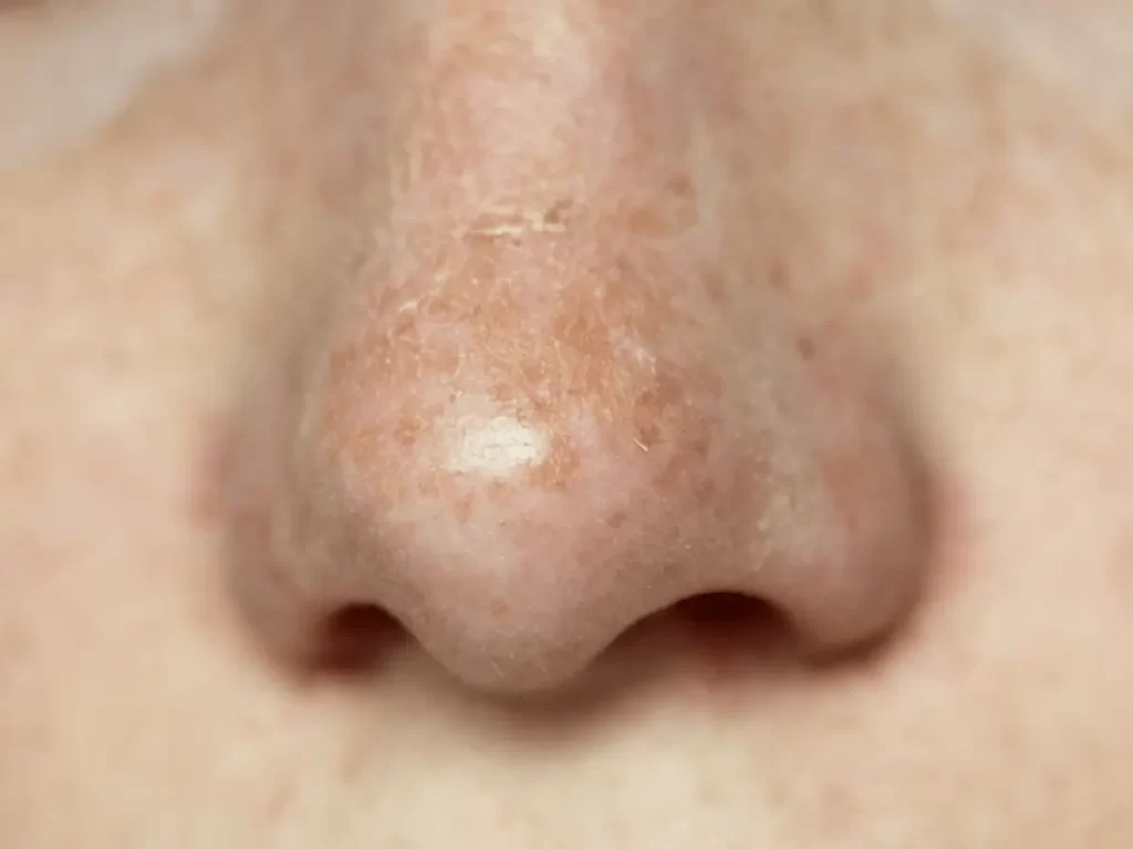 nose skin