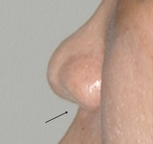 nasal tip with annotation