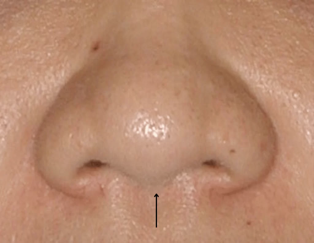 nasal tip