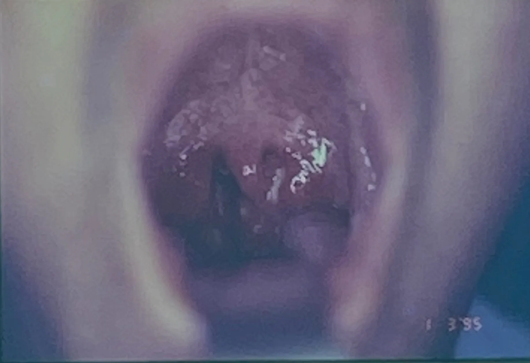 tonsillitis - throat diseases