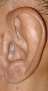 Ear Cartilage for Rhinoplasty